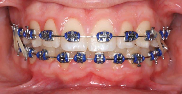brackets metálicos