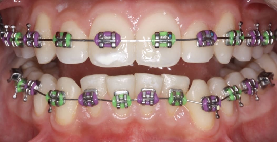 consejos cuidado de brackets