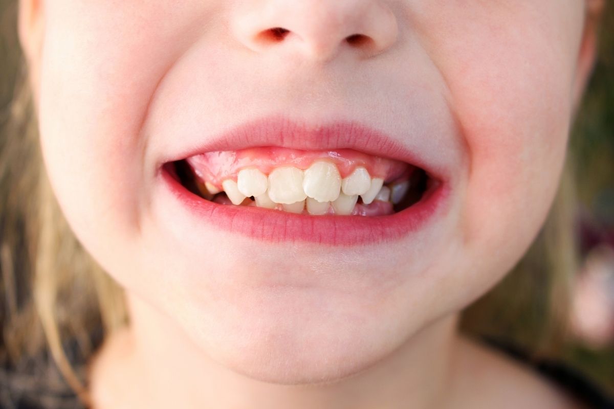 Apiñamiento dental