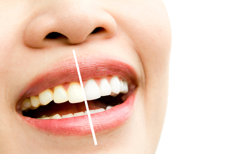 vapear es malo para los dientes