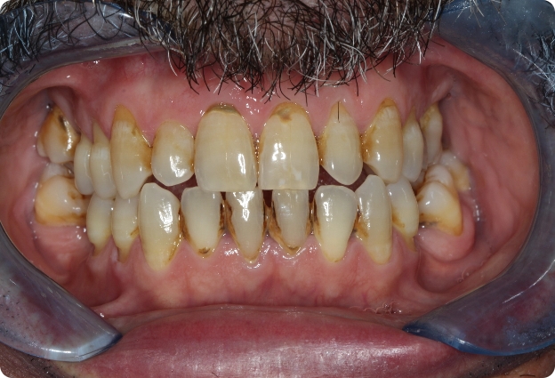 Tratamiento periodontal